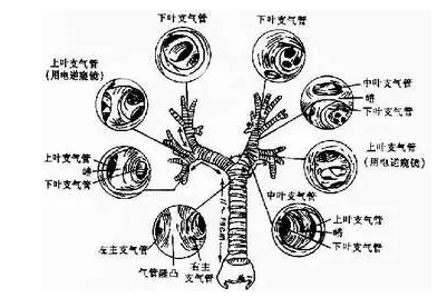 慢性支气管炎