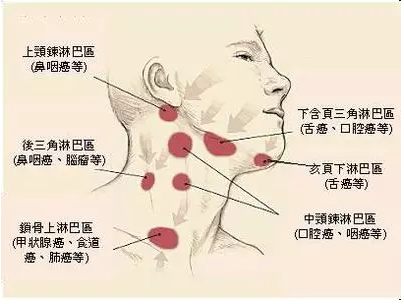 淋巴结肿大