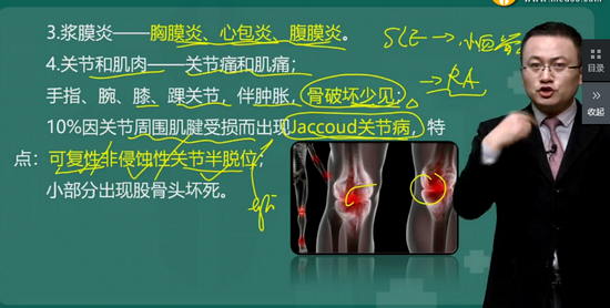 系统性红斑狼疮