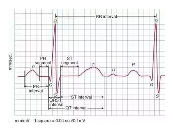 心电图