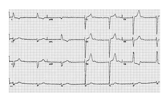 心电图