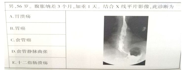 食管静脉曲张